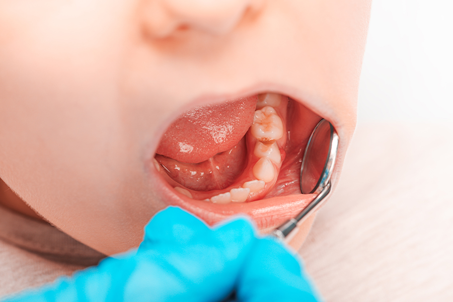 歯並び(小児矯正)のご相談