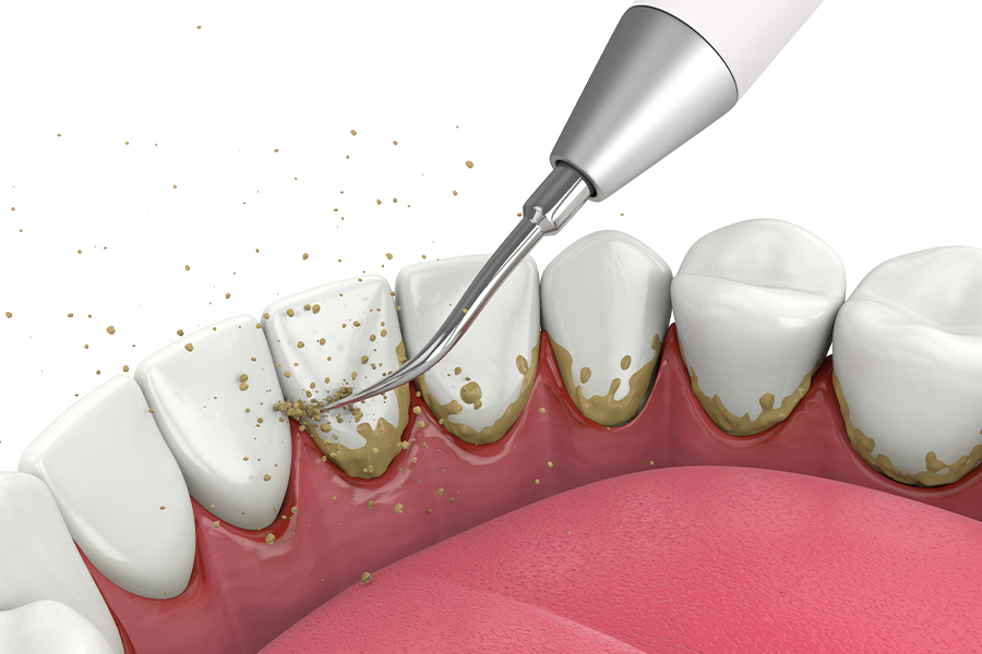 スケーリング・ルートプレーニング